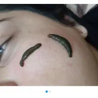 حجامت عام وکبد بادکش گرم زالودرمانی فصدخون امبدینگ