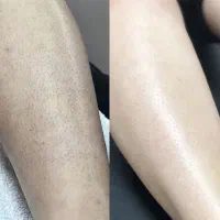 جشنواره یلدایی لیزر موهای زائد بانوان