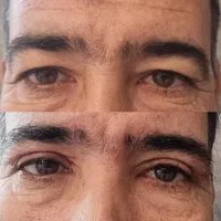 عمل(افتادگی پلک بالا و پایین )عمل زیبایی( گوش)|خدمات آرایشگری و زیبایی|فسا, |دیوار