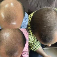 درمان سریع ریزش مو