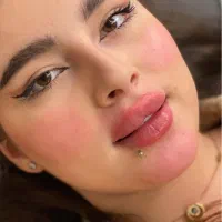 جشنواره یلدایی مطب زیبایی ژل لب وفیلرصورت