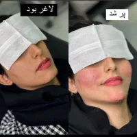 فیلر ژل بوتاکس مزو لیزر هایفو فول فیس ۵۰٪ آف|خدمات آرایشگری و زیبایی|مشهد, فرهنگ|دیوار