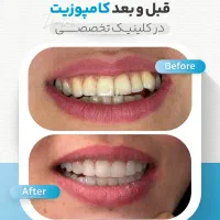 کامپوزیت/دندانپزشکی/دندان/گرگان