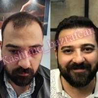 کاشت مو تکنسین شیرازی در تبریز