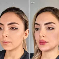 جشنواره ژل و بوتاکس و فیلر بادی(بدن)|خدمات آرایشگری و زیبایی|اصفهان, شهرک کاوه|دیوار
