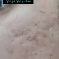 جای جوش و ابله و لک جوش|خدمات آرایشگری و زیبایی|دورود, |دیوار