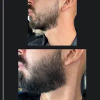 ریش و سیبیل/ ریزش مو