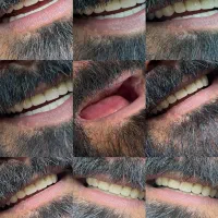 دندان مصنوعی