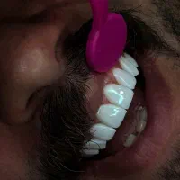 تخفیف کامپوزیت ویژه تابستانی