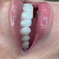 اقساط/کامپوزیت/لمینیت/روکش/ هر فک ۳تومن