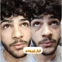 جشنواره تخفیف بوتاکس/ژل/آنزیم‌بینی/فیلرلب/فولفیس|خدمات آرایشگری و زیبایی|شیراز, زرهی|دیوار