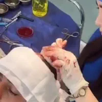 کاشت مووابرو با تخفیف درکلینیک تخصصی تبریز