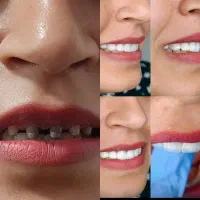 لمینت برای دندان شکسته و افتاده