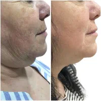 کانتورینگ صورت/ رفع غبغب/لیفت پوست/لیفت شقیقه|خدمات آرایشگری و زیبایی|مسجد سلیمان, |دیوار