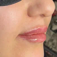 ژل و بوتاکس