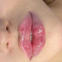 کلینیک تزریق ژللب بوتاکس390مادلینگ زاویه لیزر مزو|خدمات آرایشگری و زیبایی|تهران, صادقیه|دیوار
