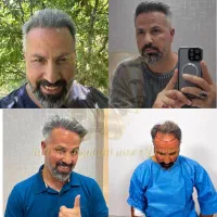 جشنواره پاییزی کاشت مو  ابرو و ریش