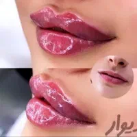 ژل لب چونه گونه زاویه بوتاکس prp لیزر مو بدن هایفو|خدمات آرایشگری و زیبایی|کرج, گوهردشت|دیوار