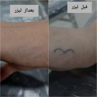 پاک کردن تاتو با دستگاه لیزر پیشرفته|خدمات آرایشگری و زیبایی|ماهدشت, |دیوار