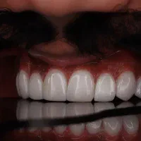 کامپوزیت/لمینیت/ایمپلنت/اقساط ویژه