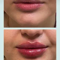 ژل فیلر بوتاکس  جوانسازتوسط پزشک زیبایی در کلینیک