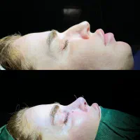 جشنواره عمل زیبایی بینی(رینوپلاستی)|خدمات آرایشگری و زیبایی|اردبیل, |دیوار