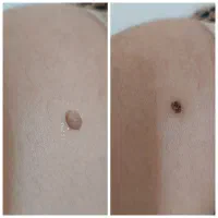 برداشتن خال و انواع ضایعه پوستی