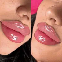 تزریق ژل بوتاکس فیلر بادی توسط پزشک در کلینیک لوکس|خدمات آرایشگری و زیبایی|مشهد, هفت تیر (حافظ)|دیوار