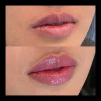 تزریق ژل و بوتاکس