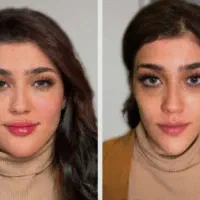 ژل بوتاکس،آنزیم،مزوژل،فیلربینی فول فیس زیرچشم