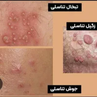 درمان قطعی زگیل بدون نیاز به جراحی و فریز|خدمات آرایشگری و زیبایی|گنبد کاووس, |دیوار