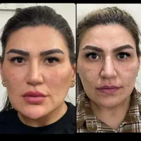 تخفیف ژل لب زاویه فک بوتاکس،لیفت بانخ،مزووایت
