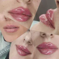 تزریق ژل|خدمات آرایشگری و زیبایی|زنجان, |دیوار