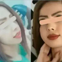 پرکننده صورت فرانسوی ۱۵روزه بدون کورتون و عوارض|آرایشی، بهداشتی، درمانی|اهواز, باغ شیخ|دیوار