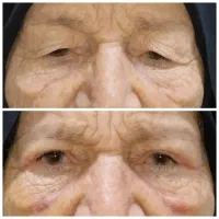 جراحی پلک بلفاروپلاستی لیفت ابرو شقیقه صورت پیشانی|خدمات آرایشگری و زیبایی|تهران, سلسبیل شمالی|دیوار