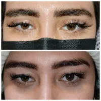 جراحی پلک بلفاروپلاستی لیفت ابرو شقیقه صورت پیشانی