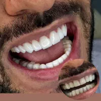 ونیر کامپوزیت تخفیف ویژه