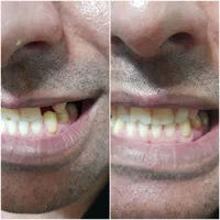 دندانسازی(دندان مصنوعی)تکی،چندتایی،کامل|آرایشی، بهداشتی، درمانی|کرمان, |دیوار