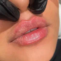 تزریق فیلر بوتاکس فیشال درمان لک جوش چین و چروک|خدمات آرایشگری و زیبایی|محمدشهر, محمدشهر|دیوار