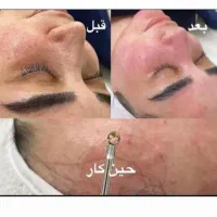 فیشیال (پاکسازی) خالبرداری و پلاسما صورت|خدمات آرایشگری و زیبایی|کوهدشت, |دیوار