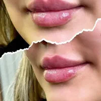مدل رایگان ژل لب گونه و بوتاکس و لیزر سه نفراول