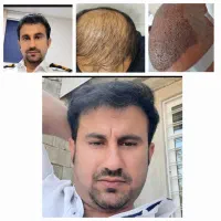 لیزرco2تک جلسه ای،تزریق چربی، دیگر خدمات زیبایی|خدمات آرایشگری و زیبایی|دهدشت, |دیوار