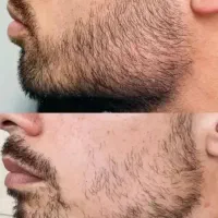 پی آرپی prp مزوتراپی مزونیدلینگ بوتاکس فشیال آنزیم|خدمات زیبایی و سلامت|تهران, دردشت|دیوار