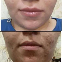 رفع لک وجوش رفع آفتاب سوختگی لک چین و چروک|آرایشی، بهداشتی، درمانی|کرج, گلدشت|دیوار