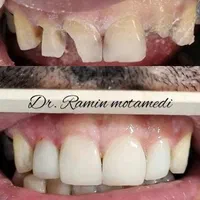 ایمپلنت/کامپوزیت/دندانپزشکی/اقساط|خدمات آرایشگری و زیبایی|شیرگاه, |دیوار