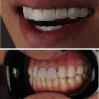 دندانپزشک اقساط کامپوزیت لمینیت لب شیشه ای بلیچینگ|خدمات آرایشگری و زیبایی|مشهد, سجاد شهر|دیوار