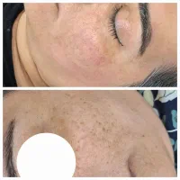 فیشال و پاکسازی پوست