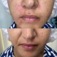 مطب پزشک.ژل وبوتاکس.لیفت بانخ.فیلربینی ژل آلت|خدمات آرایشگری و زیبایی|قم, دورشهر|دیوار