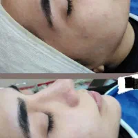 ۳۰٪ تخفیف فیشیال و پاکسازی پوست به مدت محدود