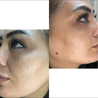 رفع لک و تیرگی صورت و بدن